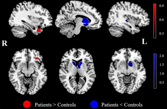 Figure 4. MID‐evoked activation differences during the reward outcome phase between AUD patients and HC in the meta‐analysis
