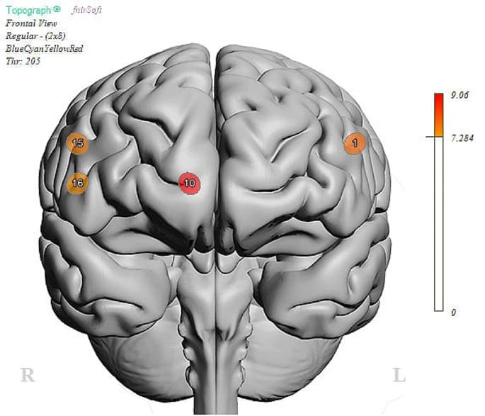 Fig. 4 Parametric plot for main effects of Group (SI vs. N-SI) during affective Go-NoGo task.