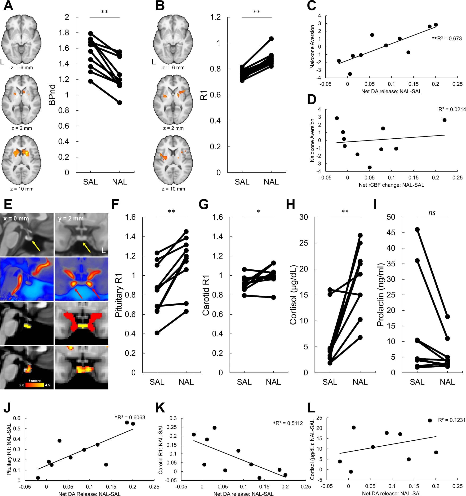 Fig. 1: Naloxone precipitated withdrawal affects dopamine release and relative cerebral blood flow in OUD men.