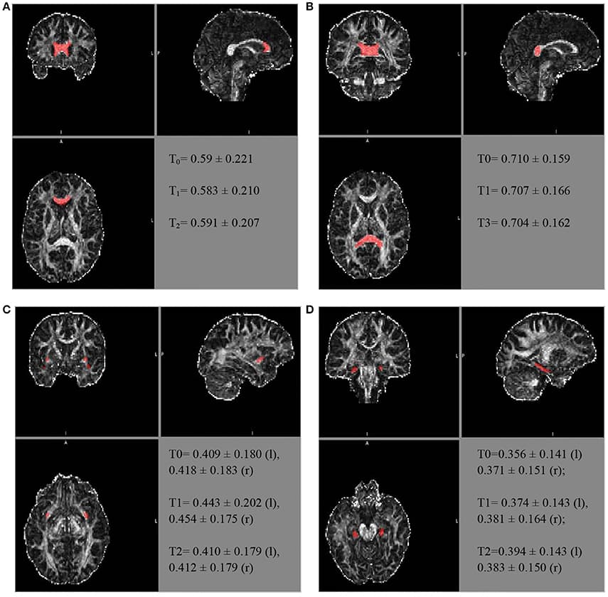 Frontiers Brain Maturation, Cognition and Voice Pattern in a Gender Dysphoria Case under Pubertal Suppression