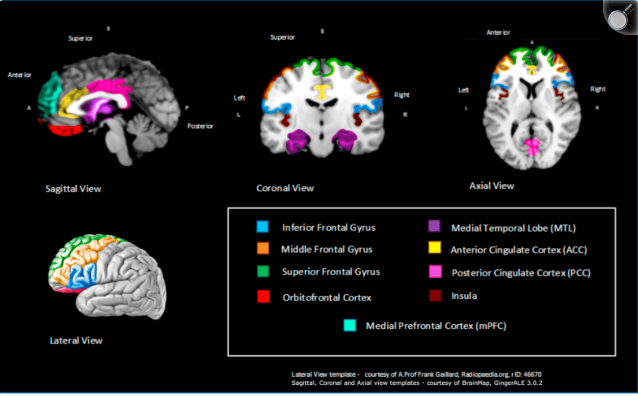Fig. 2. Schematic representation of key brain regions significantly associated with anosognosia or metacognition from at least 2 structural studies.
