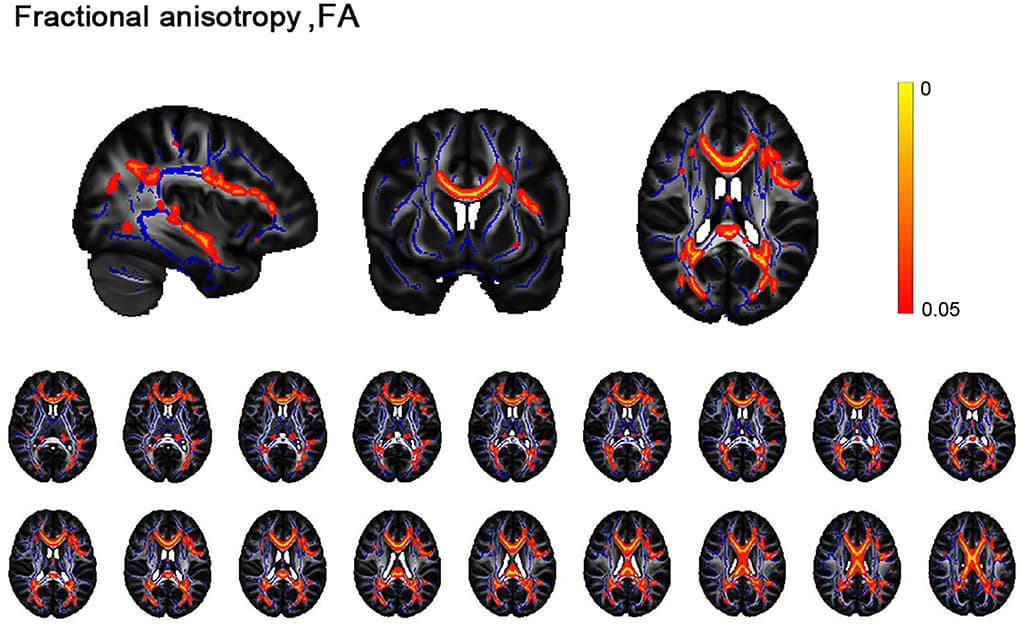 Figure 1. Differences between alcohol dependence (AD) cohorts and healthy controls (HC) in the white matter skeleton
