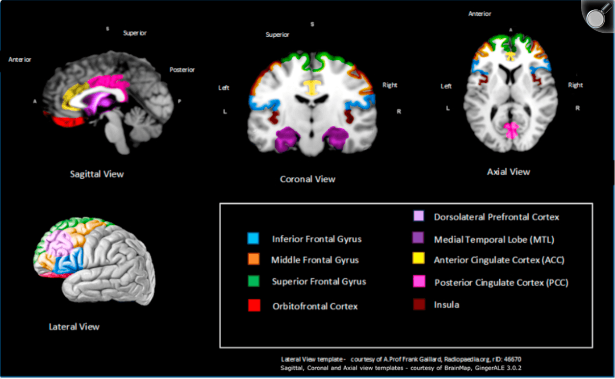 Figure 3. Schematic representation of key brain regions significantly associated with anosognosia from at least 2 functional modalities.
