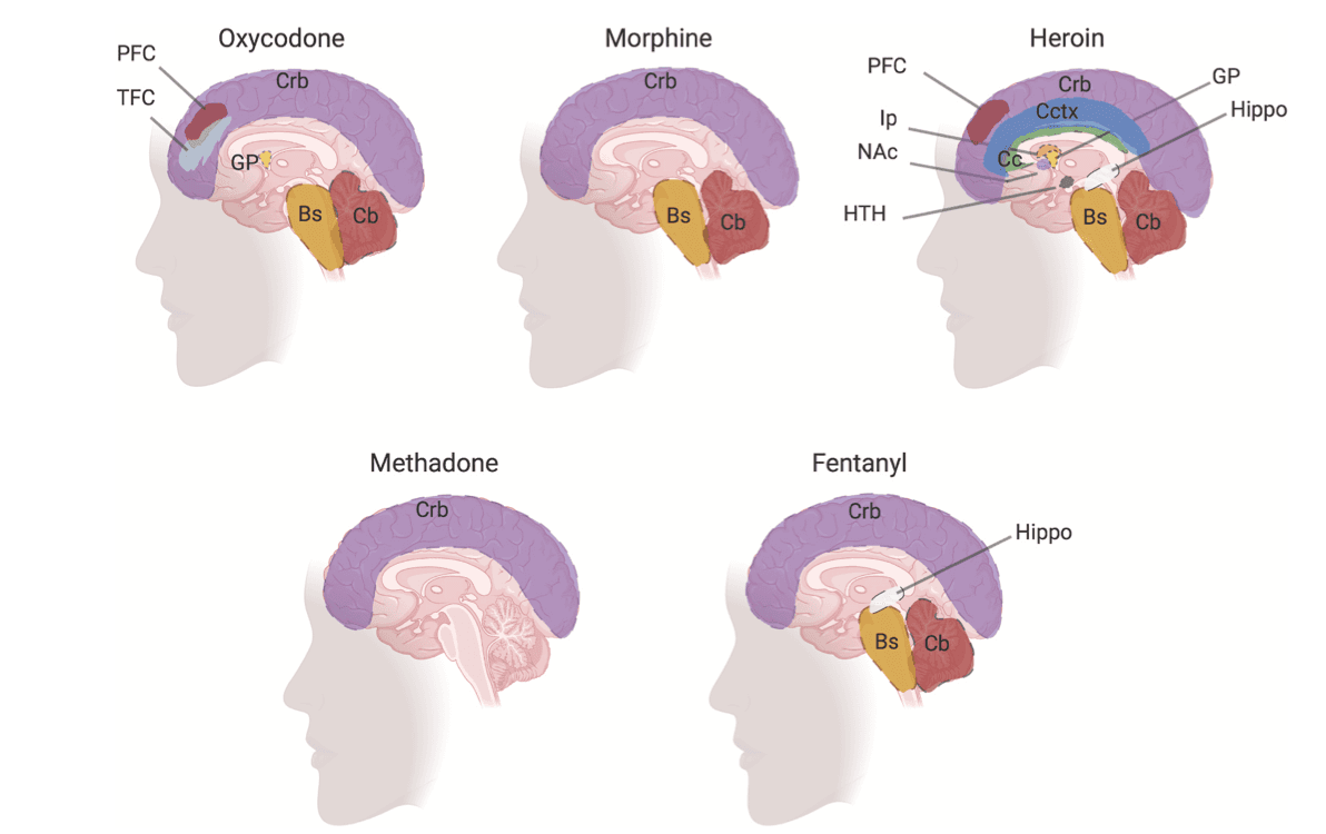 Fig. 2. Brain deficits in human opioid use disorders
