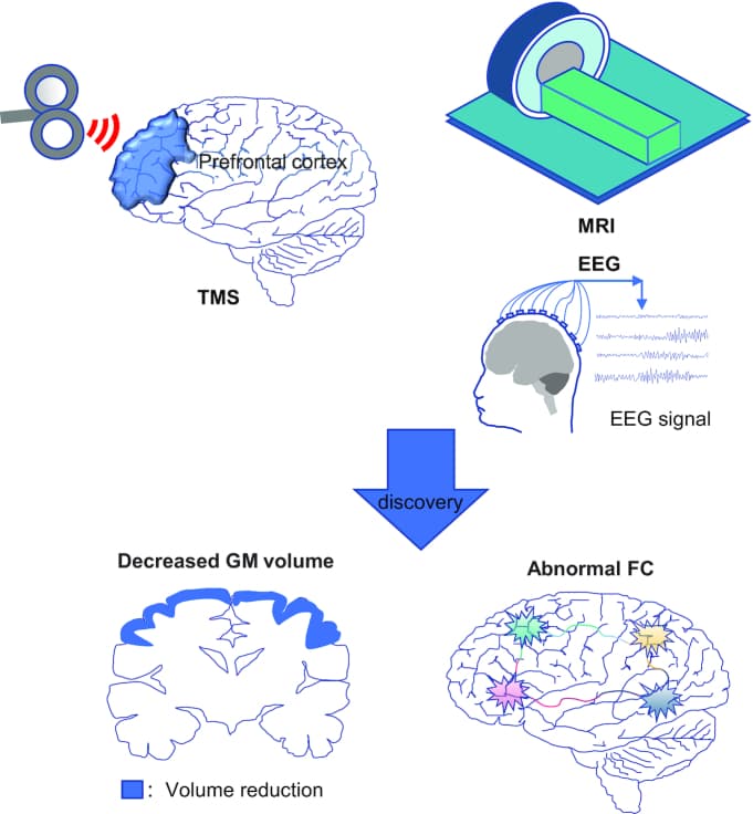 Fig. 1 Changes in brain structure and function in patients with AUD.