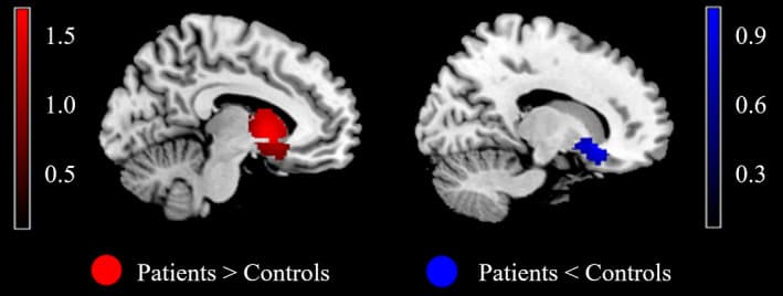 Fig. 5. MID‐evoked activation differences between reward anticipation and reward outcome in the meta‐analysis.