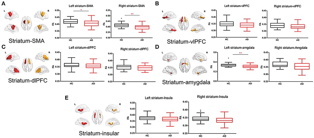 Figure 3. White matter integrity of striatal circuit structural connection comparisons between AD and HC.