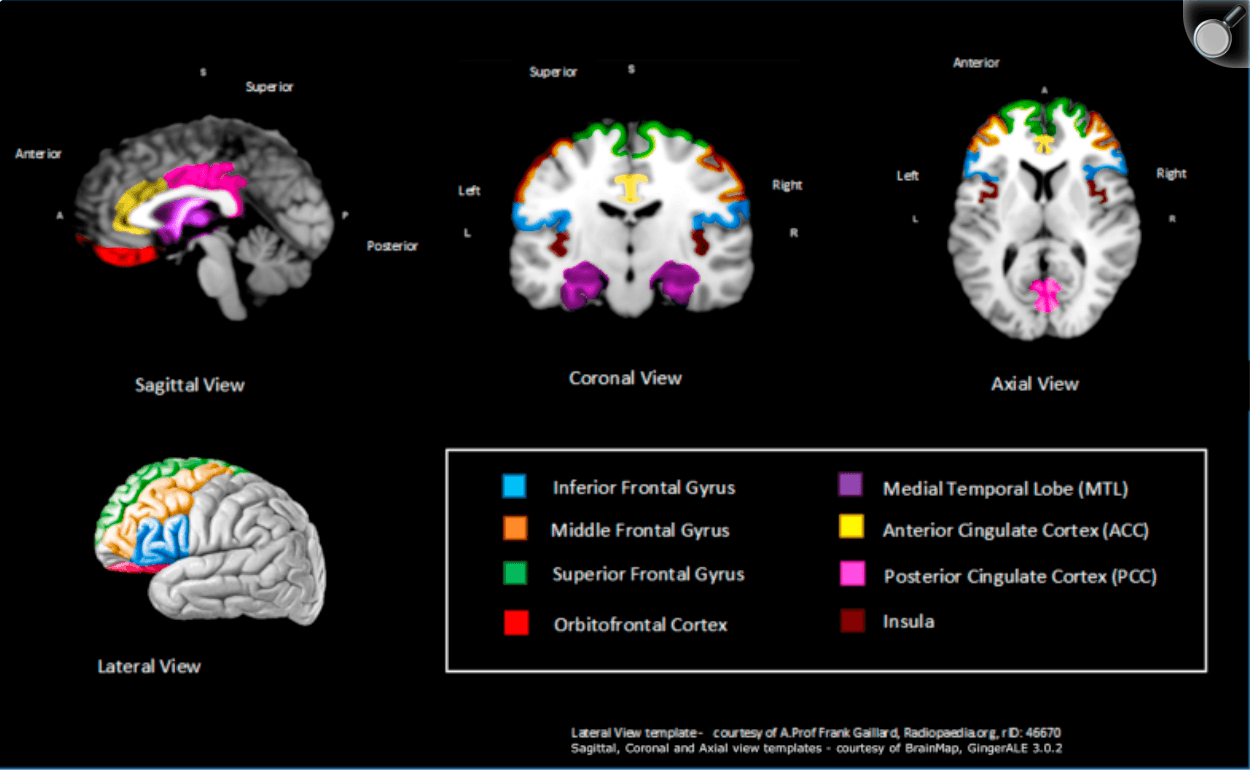Figure 4. Schematic representation of overall key brain regions significantly associated with anosognosia—across at least 2 structural and 2 functional studies.